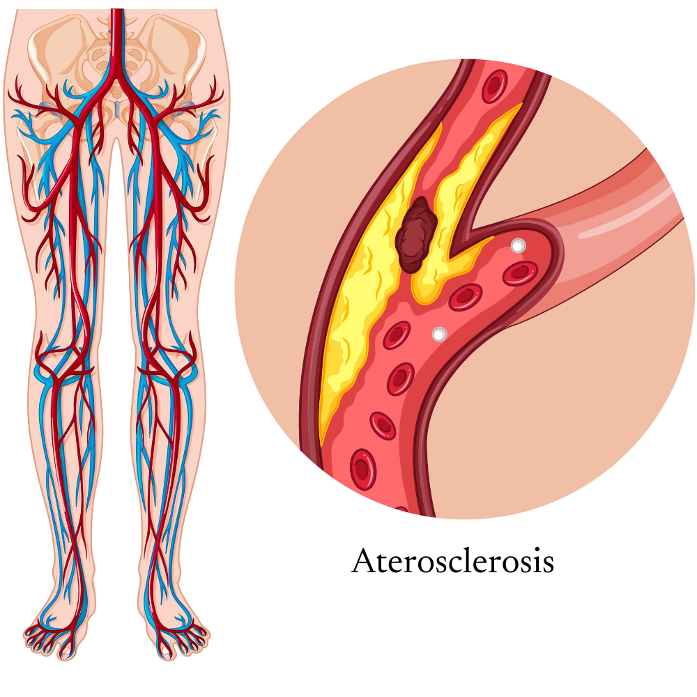 Aterosclerosis